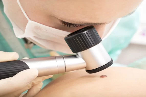 Skin Cancer Screening