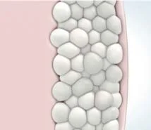 CoolSculpting Gold Coast