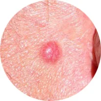 Basal Cell Carcinoma Pink Growth