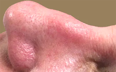 broken capillaries treatment gold coast broken capillaries treatment gold coast