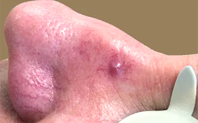 broken capillaries treatment gold coast broken capillaries treatment gold coast