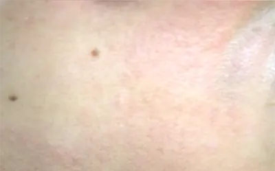 broken capillaries treatment gold coast broken capillaries treatment gold coast