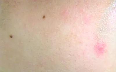 broken capillaries treatment gold coast broken capillaries treatment gold coast