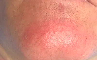 broken capillaries treatment gold coast broken capillaries treatment gold coast