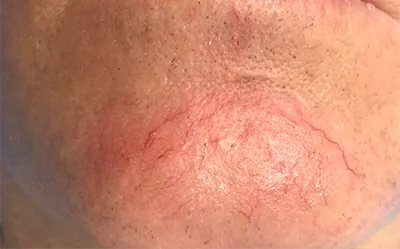 broken capillaries treatment gold coast broken capillaries treatment gold coast