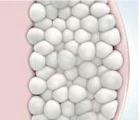 CoolSculpting 2 CoolSculpting 2