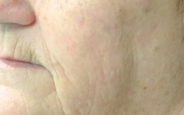 laser pigmentation removal gold coast laser pigmentation removal gold coast