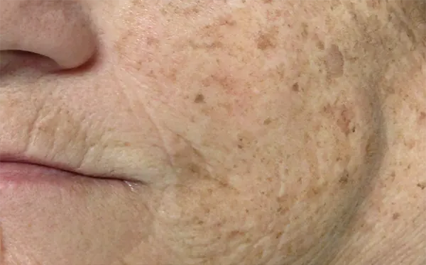 laser pigmentation removal gold coast laser pigmentation removal gold coast