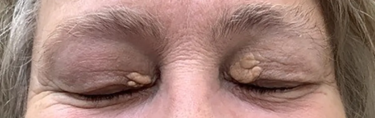 xanthelasma treatment gold coast