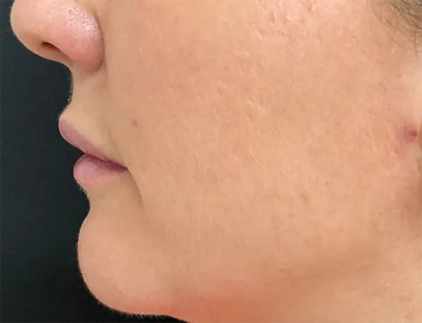 cosmelan-after cosmelan-after