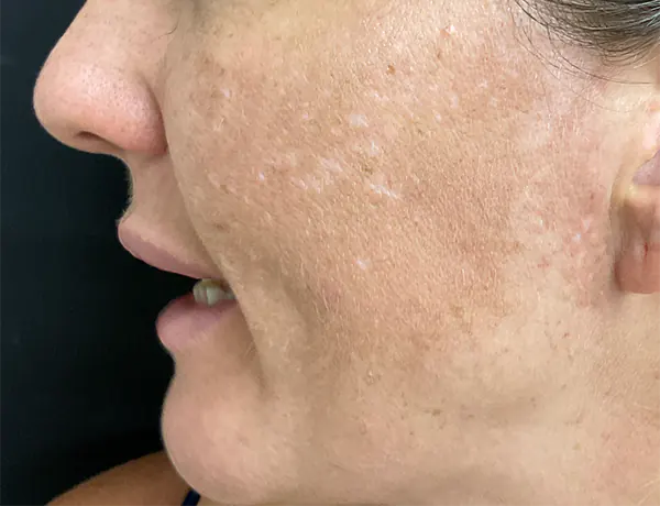 cosmelan-before cosmelan-before