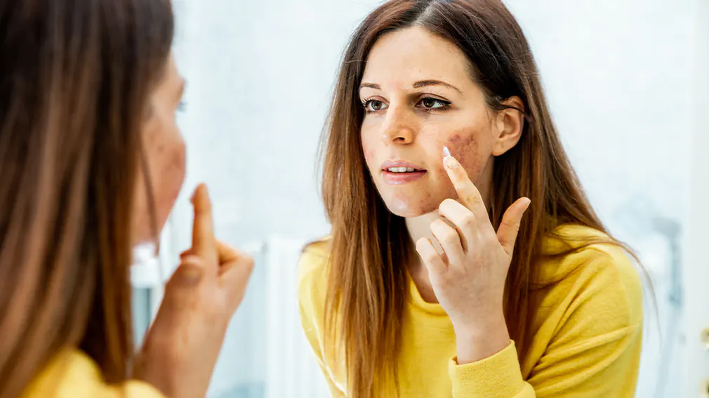 melasma-causes-clinical-treatment-methods
