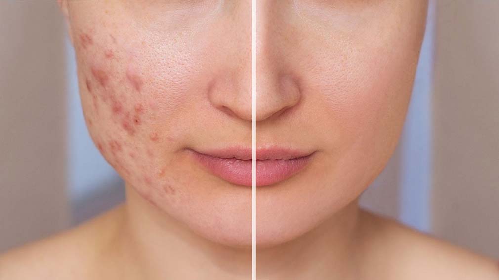 How Subcision Is Used to Treat Acne Scars