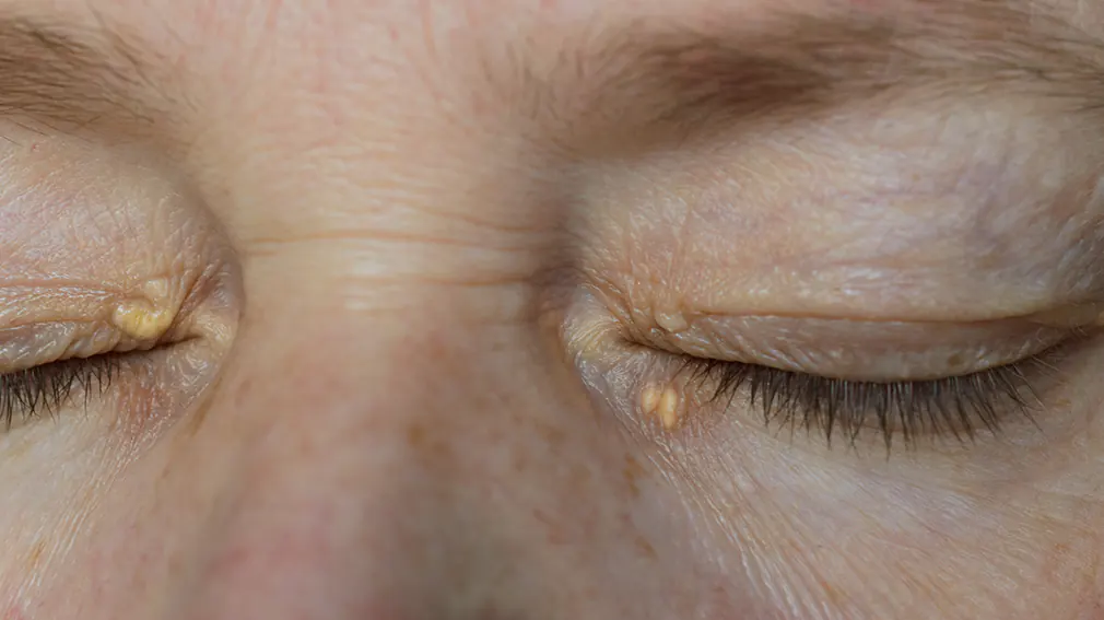 xanthelasma-treatment-removal-gold-coast