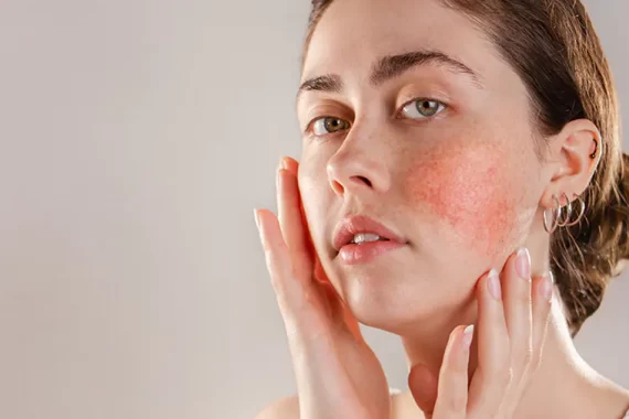 broken-cappillaries-gold-coast