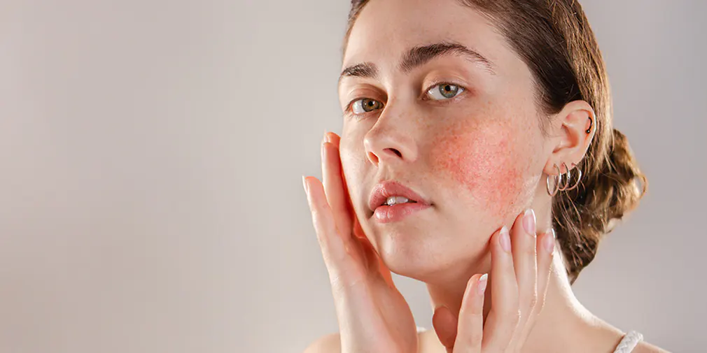 broken-cappillaries-gold-coast