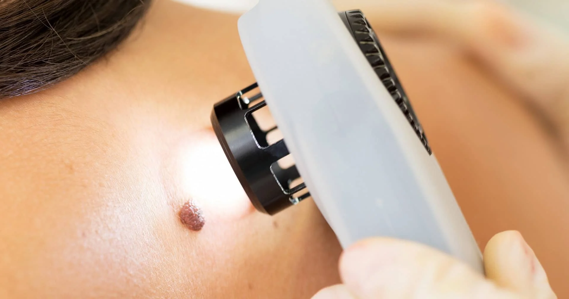 Squamous Cell Carcinoma Squamous Cell Carcinoma