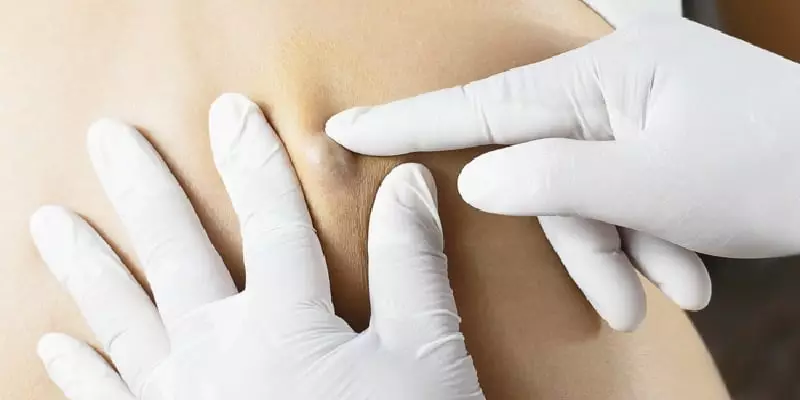 Cyst Removal Surgery