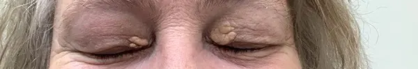 xanthelasma treatment gold coast
