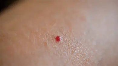 cherry angioma removal gold coast
