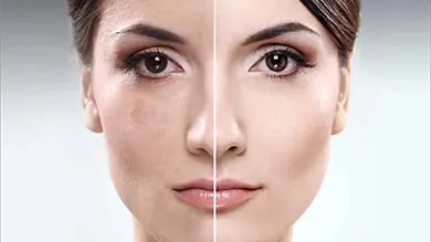 laser pigmentation removal gold coast