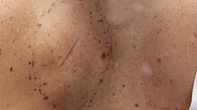 lipoma removal gold coast