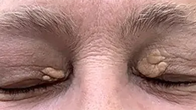 xanthelasma treatment gold coast