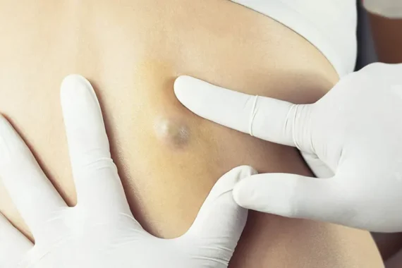 Epidermoid and Pilar cysts: Causes, Symptoms & Removal