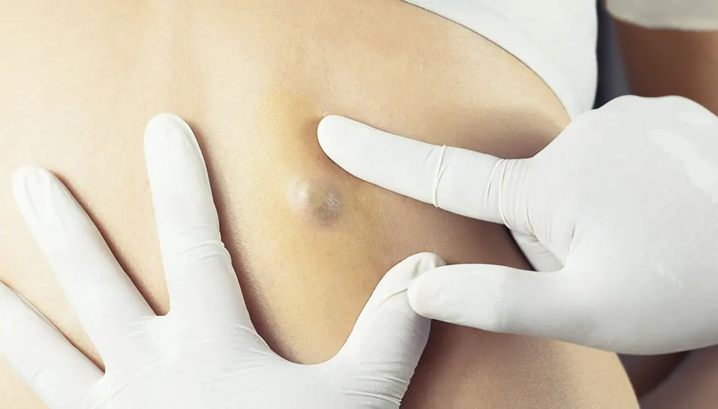 Epidermoid and Pilar cysts: Causes, Symptoms & Removal