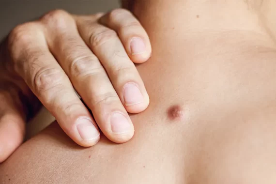 Reasons Why You Shouldn't Pop or Burst a Sebaceous Cyst