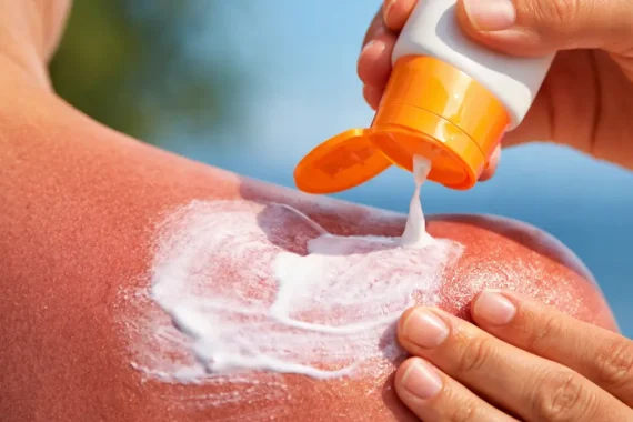 Apply Sunscreen to Sunburnt Skin