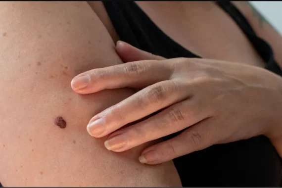 Melanoma Progress