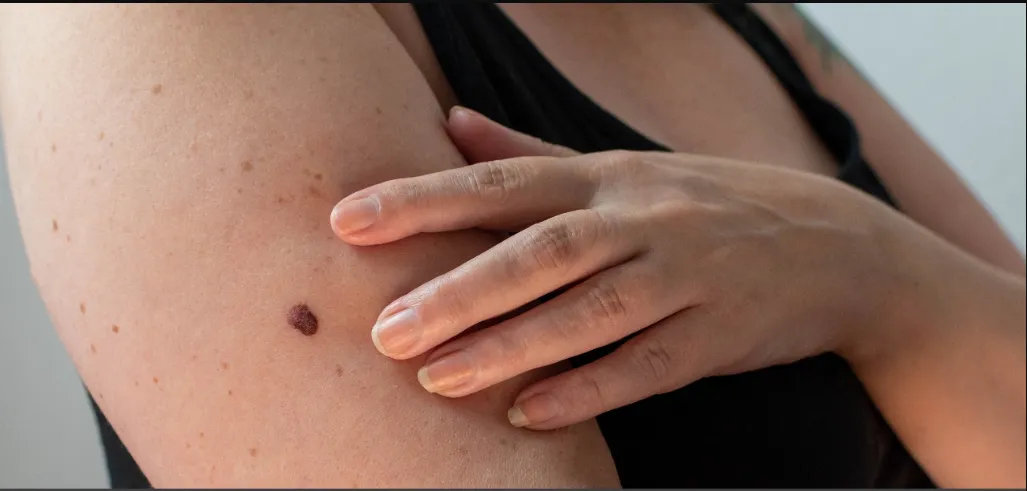 Melanoma Progress