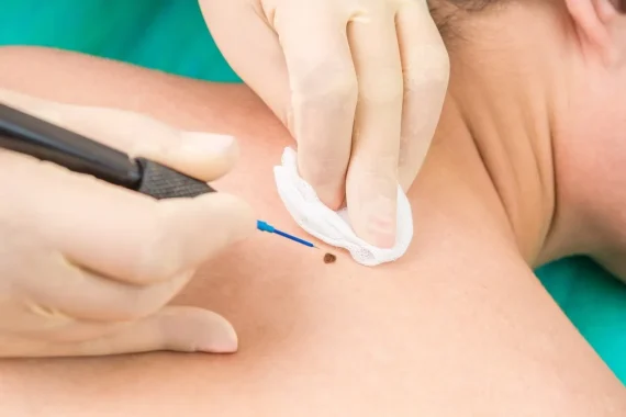 Skin Cancer Treatment