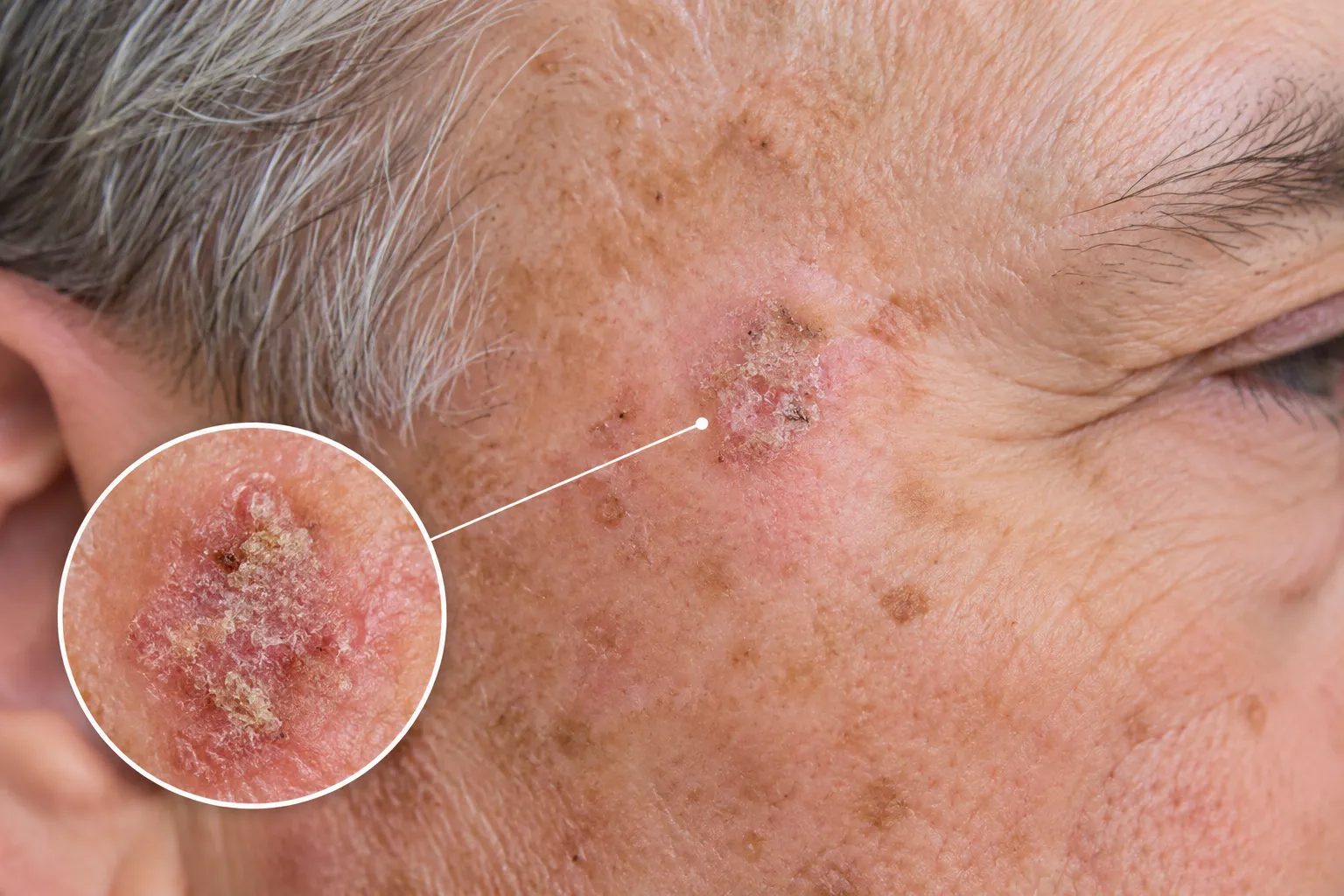 Actinic Keratosis